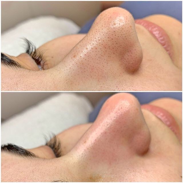 Resultado de tratamiento facial MG Skinbeauty